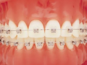 Брекеты из керамики: красота без жертв